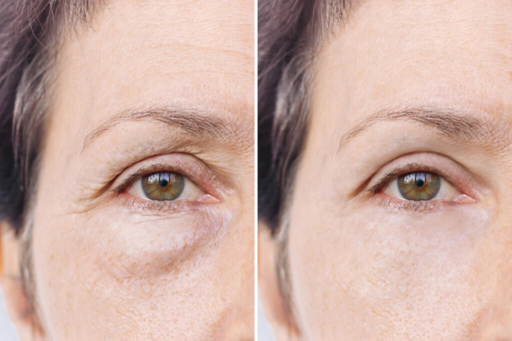 Blefaroplastia (Cirugía de Párpados)