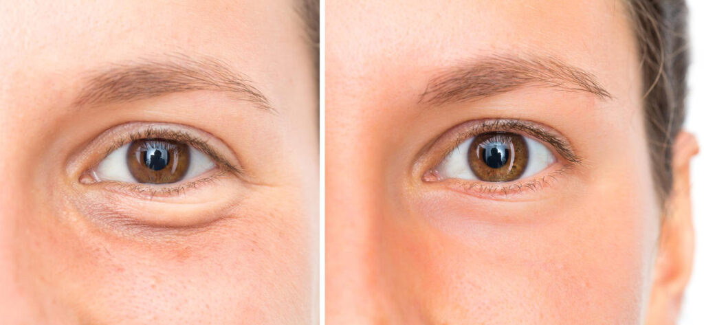 Blefaroplastia (Cirugía de Párpados)