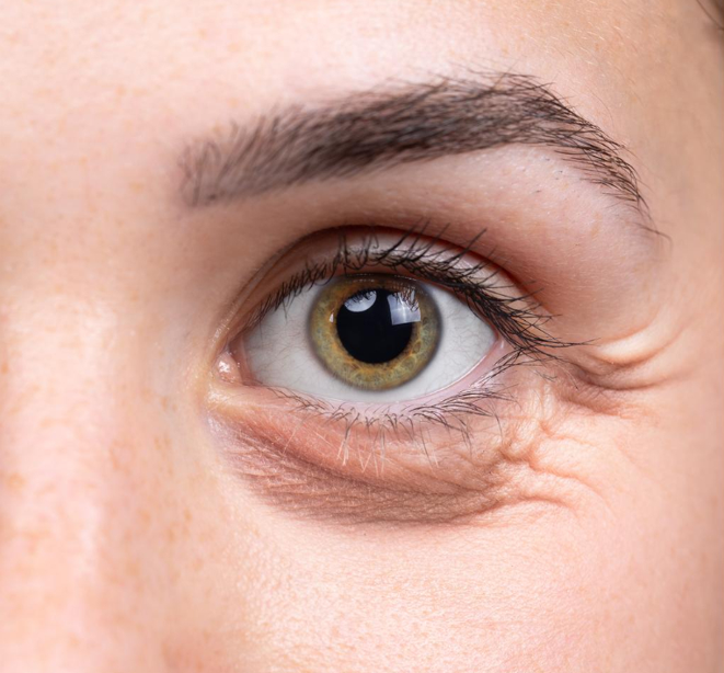 Blefaroplastia (Cirugía de Párpados)