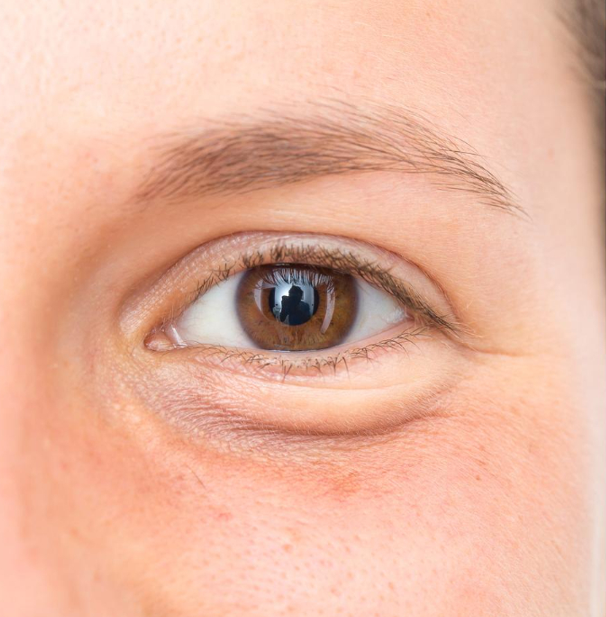 Blefaroplastia (Cirugía de Párpados)