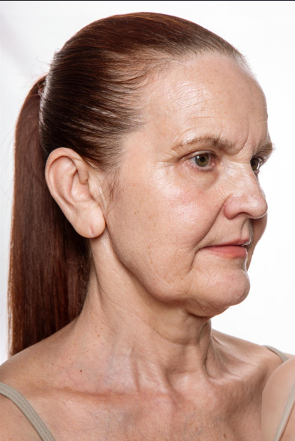Lifting facial 4 Lifting facial