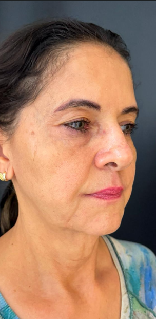 Lifting facial 4 Lifting facial