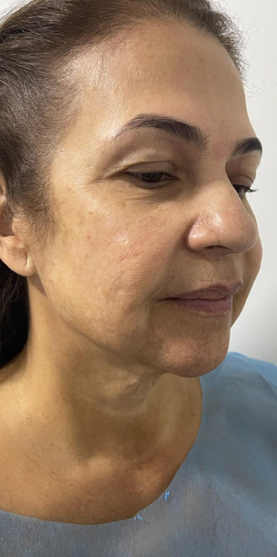 Lifting facial 2 Lifting facial