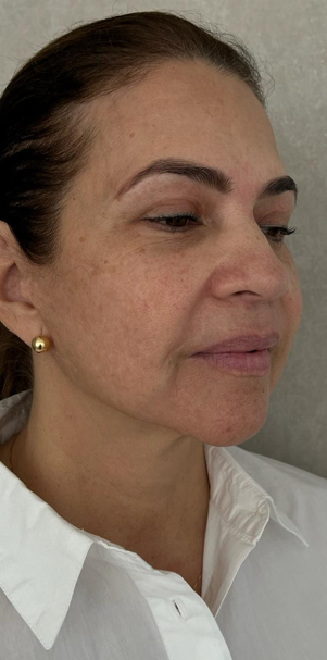 Lifting facial 3 Lifting facial