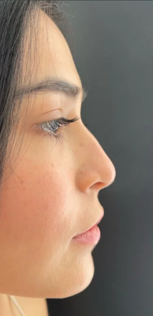 Rinoplastia Ultrasónica