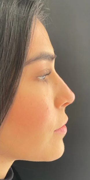 Rinoplastia Ultrasónica