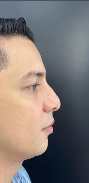 Rinoplastia Ultrasónica