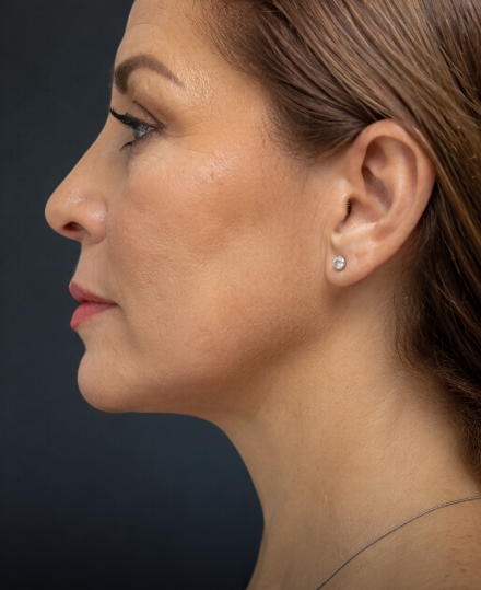 Cervicoplastia 