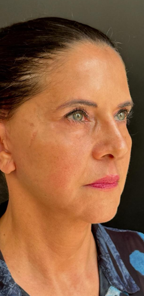 Lifting facial 5 Lifting facial