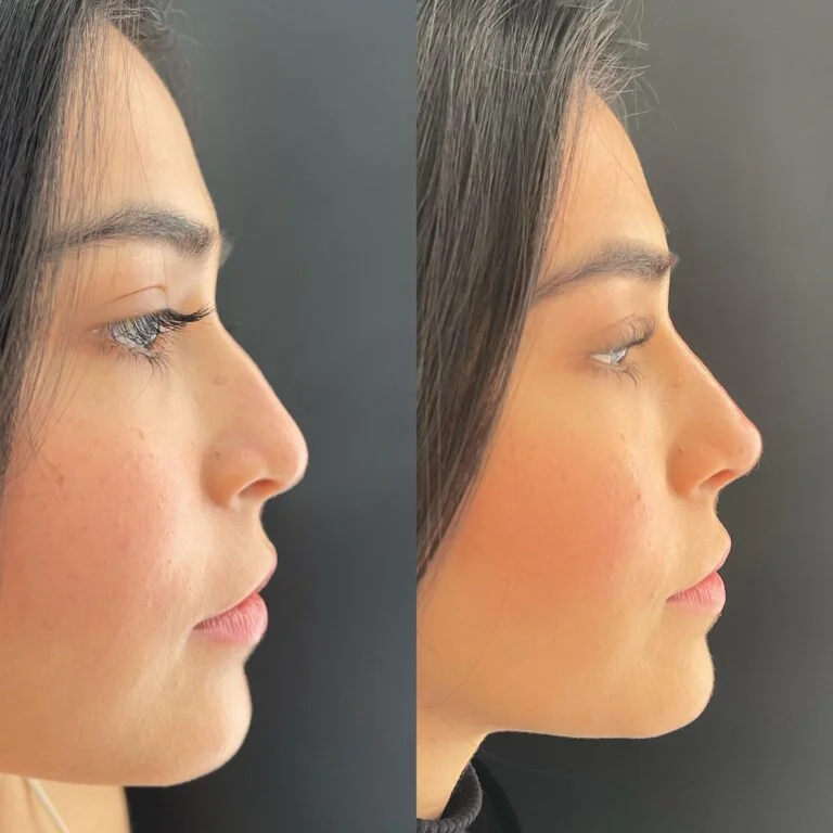 Rinoplastia Ultrasónica