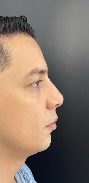 Rinoplastia Ultrasónica