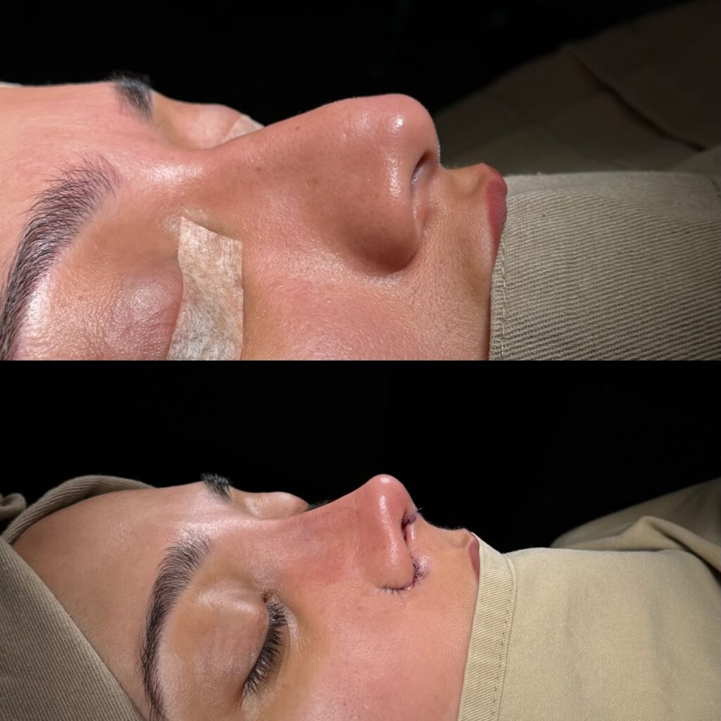 Rinoplastia Ultrasónica 9 Rinoplastia Ultrasónica