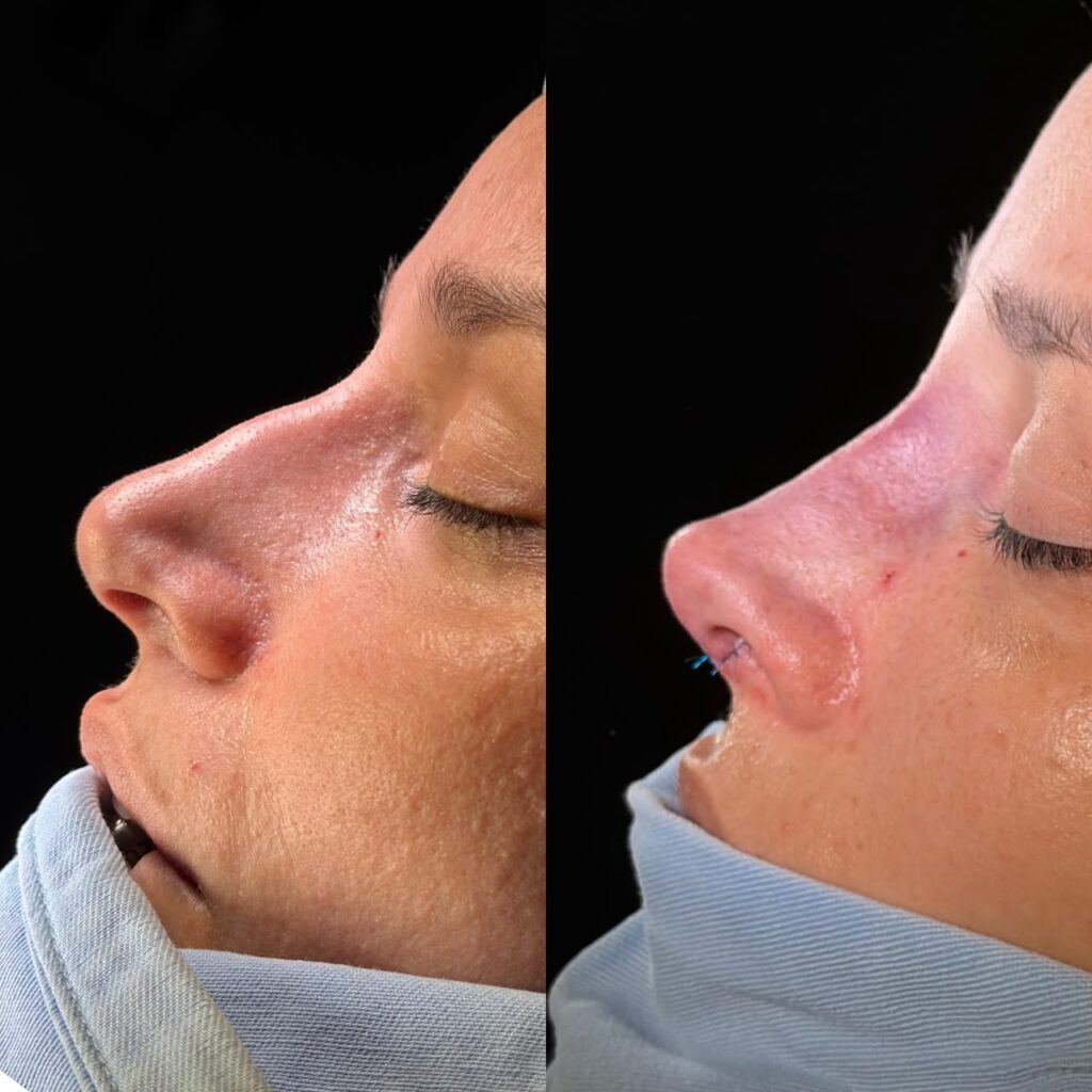 Rinoplastia Ultrasónica 8 Rinoplastia Ultrasónica
