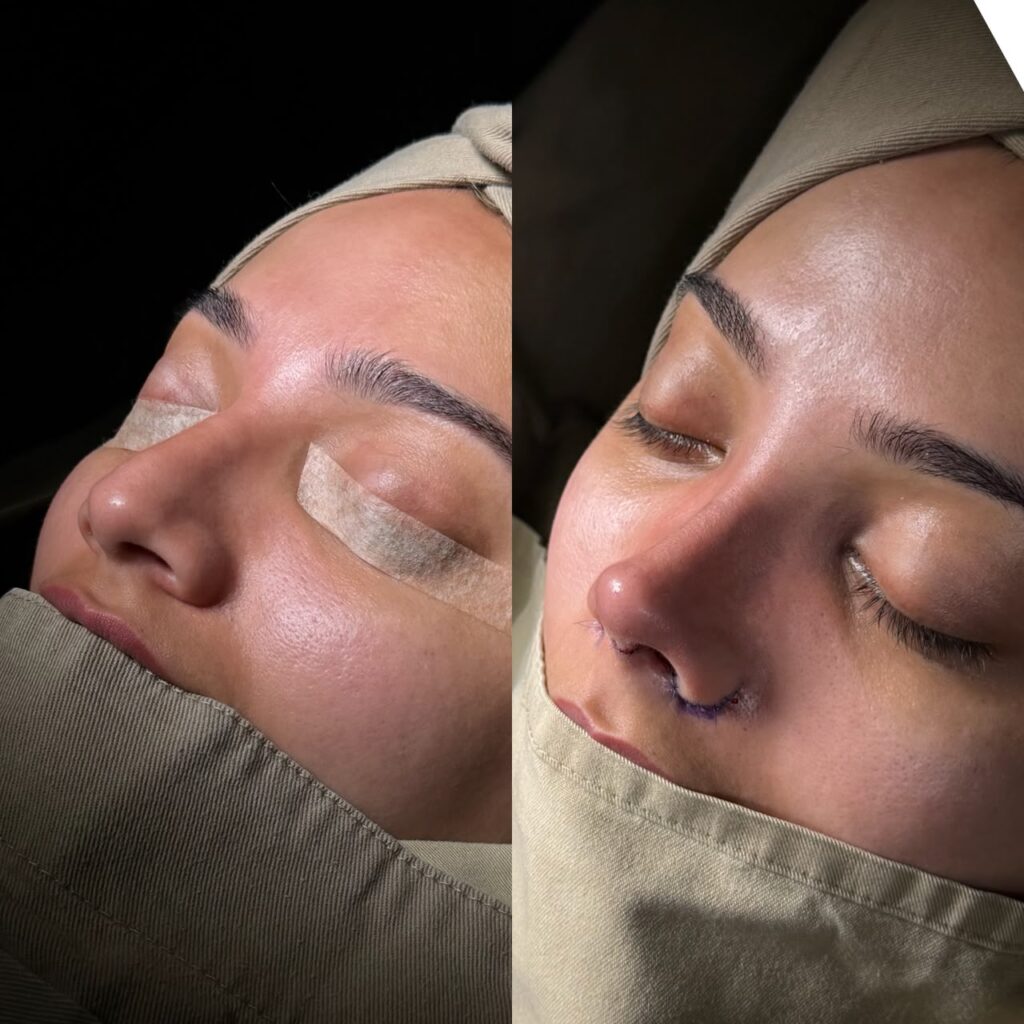 Rinoplastia Ultrasónica 7 Rinoplastia Ultrasónica