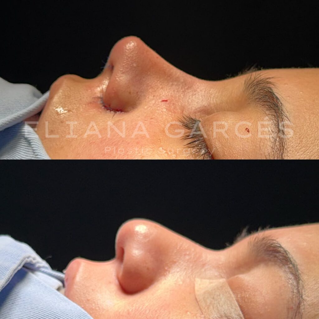 Rinoplastia Ultrasónica 6 Rinoplastia Ultrasónica