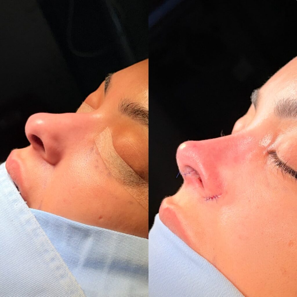 Rinoplastia Ultrasónica 5 Rinoplastia Ultrasónica