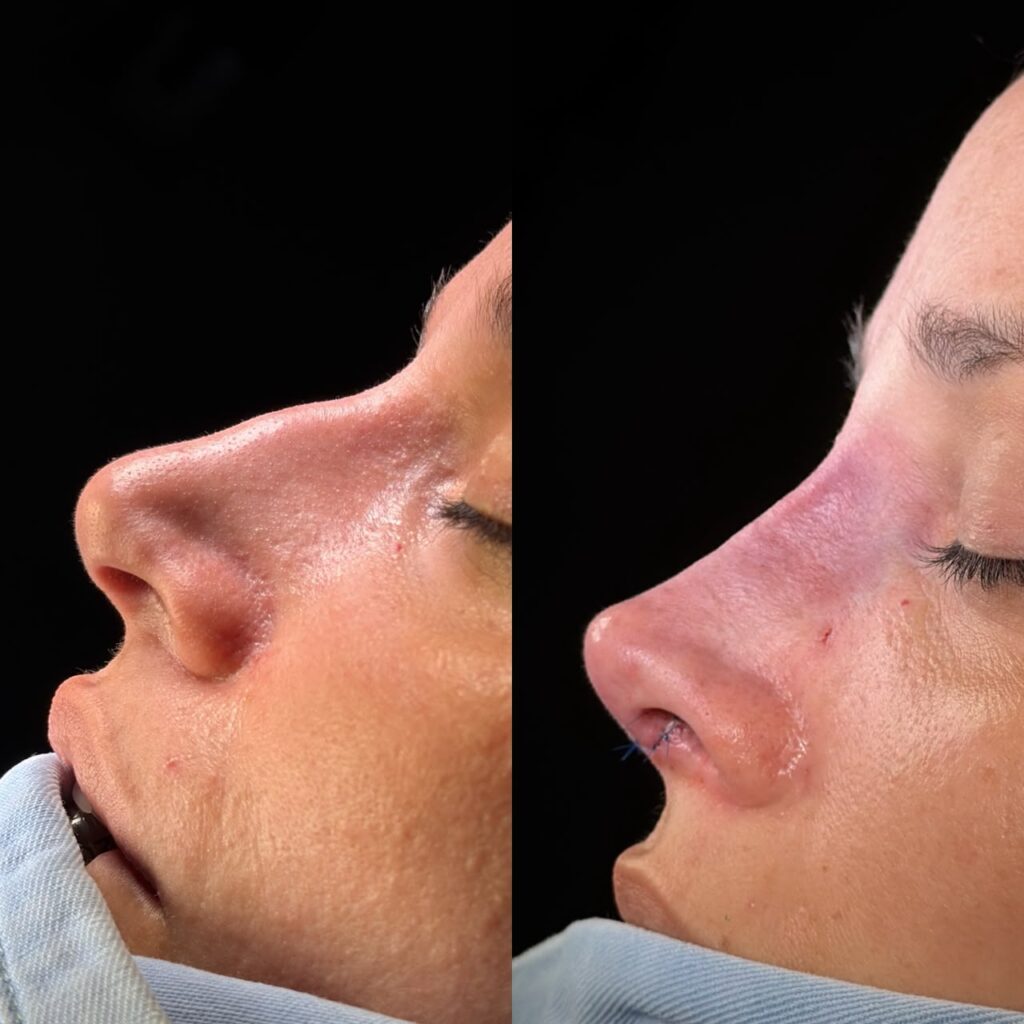 Rinoplastia Ultrasónica 4 Rinoplastia Ultrasónica