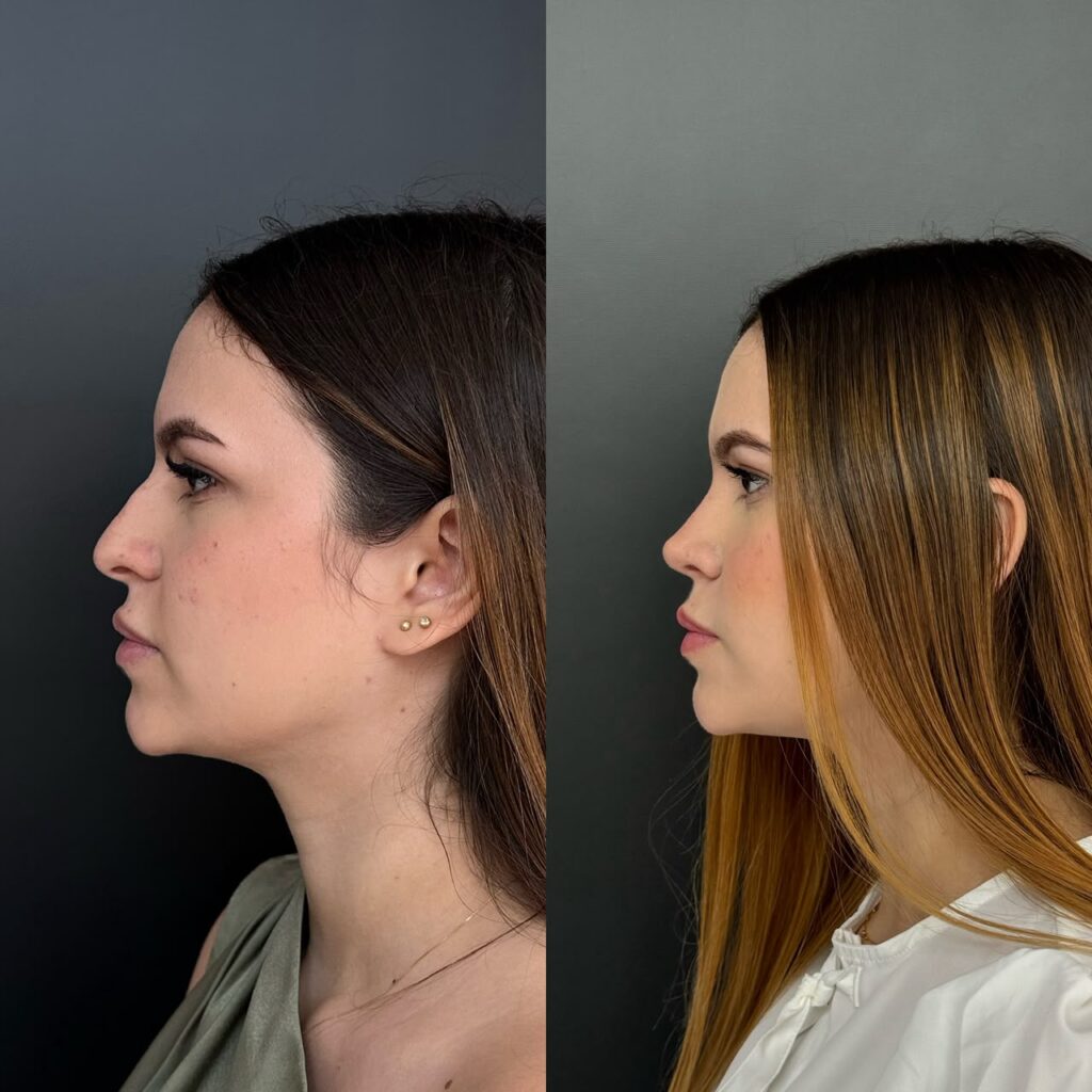 Rinoplastia Ultrasónica 3 Rinoplastia Ultrasónica