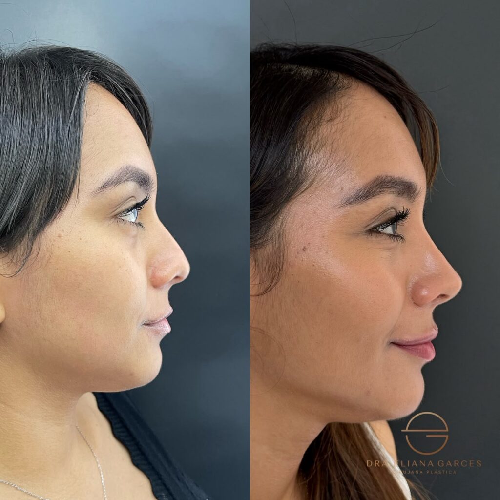Rinoplastia Ultrasónica 2 Rinoplastia Ultrasónica