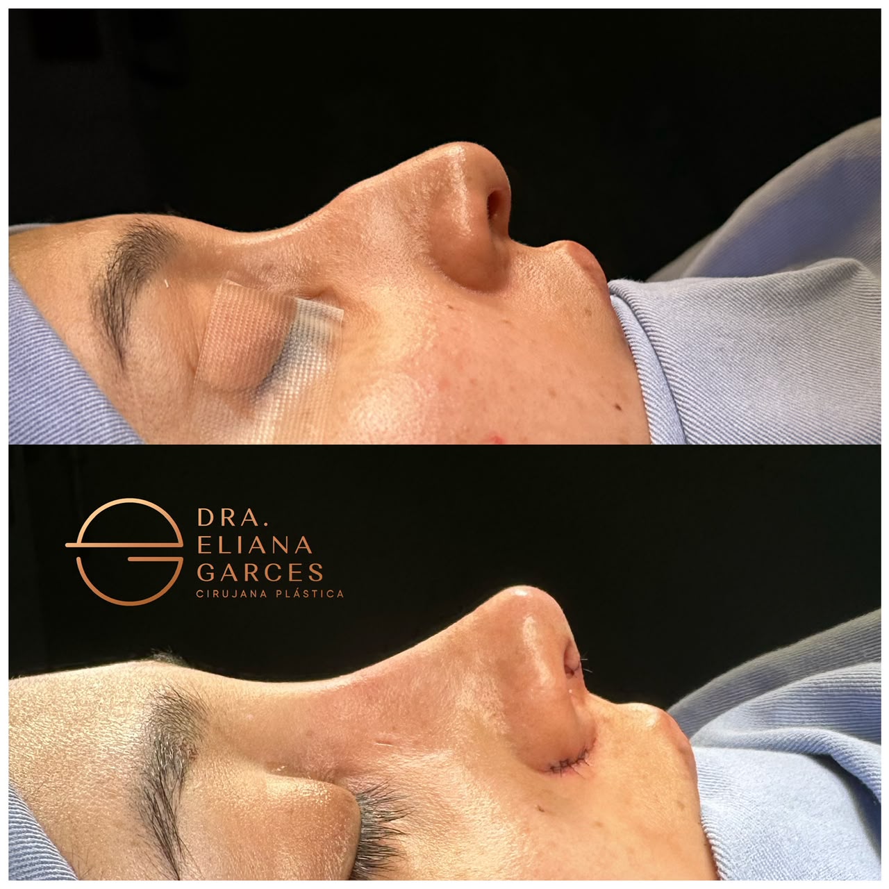 Rinoplastia Ultrasónica 1 Rinoplastia Ultrasónica